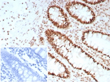 SATB2 Antibody Rabbit Monoclonal Colon Carcinoma IHC. Immunohistochemistry of SATB2 antibody in FFPE human colon carcinoma tissue. The rabbit monoclonal SATB2 antibody (clone SATB2/8697R) demonstrates strong nuclear staining in malignant glandular epithelial cells, consistent with SATB2 expression in colorectal epithelium. Adjacent stromal elements show minimal to no staining. The negative control inset shows tissue treated with PBS in place of the primary antibody, confirming absence of non-specific secondary antibody binding. Heat-induced epitope retrieval was performed by boiling sections in pH 9 10mM Tris with 1mM EDTA for 20 minutes followed by cooling prior to staining.