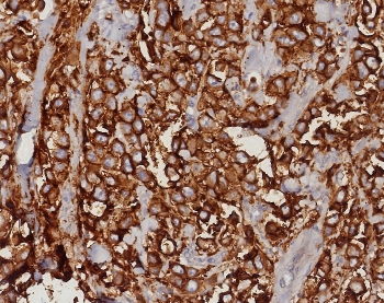 IHC staining of FFPE human mammary carcinoma tissue with EpCAM antibody (clone EGP40/8191R). HIER: boil tissue sections in pH 9 10mM Tris with 1mM EDTA for 20 min and allow to cool before testing.