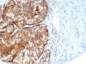 CD26 Antibody Kidney Cancer IHC. Immunohistochemistry analysis of FFPE human kidney cancer tissue stained with a mouse monoclonal CD26 antibody recognizing Dipeptidyl peptidase 4 (DPP4). The antibody clone DPP4/7415 demonstrates strong membranous and cytoplasmic staining in tumor epithelial cells, highlighting CD26 as a membrane-associated enzymatic marker with known roles in peptide processing and immune-related signaling. The staining pattern supports the utility of this antibody for studying DPP4 expression in tumor cells and its relevance to T cell activation pathways within the tumor microenvironment. Hematoxylin counterstain highlights nuclei in blue. HIER: boil tissue sections in pH 9 10 mM Tris with 1 mM EDTA for 20 min and allow to cool before testing.