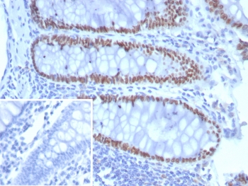 Immunohistochemistry of SATB2 antibody in FFPE human colon carcinoma tissue. The recombinant rabbit monoclonal SATB2 antibody (clone SATB2/8292R) demonstrates strong nuclear staining in malignant gland-forming epithelial cells, consistent with SATB2 expression in colorectal epithelium. Surrounding stromal cells show minimal to no staining. The negative control inset, in which PBS was used in place of the primary antibody, confirms absence of non-specific secondary antibody binding. Heat-induced epitope retrieval was performed by boiling sections in pH 9 10mM Tris with 1mM EDTA for 20 minutes followed by cooling prior to staining.