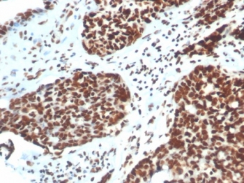 XRCC5 Antibody Colon IHC. Immunohistochemistry analysis of human colon tissue using XRCC5 antibody clone XRCC5/7316. Formalin-fixed, paraffin-embedded sections show strong HRP-DAB brown nuclear staining in glandular epithelial cells, consistent with XRCC5 (Ku80) localization as part of the Ku heterodimer. The prominent nuclear signal reflects active DNA end-binding at sites of DNA maintenance and repair within proliferative epithelial compartments. Hematoxylin counterstain highlights nuclei (blue), providing contrast to the XRCC5-positive nuclear staining pattern.