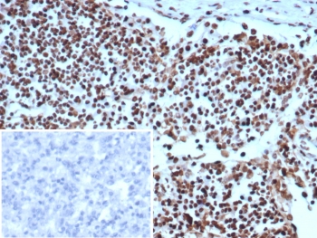 XRCC5 Antibody Human Lymph Node Tissue IHC. Immunohistochemistry analysis of human lymph node tissue using XRCC5 antibody clone XRCC5/7314. Formalin-fixed, paraffin-embedded sections show strong HRP-DAB brown nuclear staining throughout the lymphoid cell population, consistent with XRCC5 (Ku80) expression in cells actively maintaining genomic integrity. The widespread nuclear signal reflects continuous DNA repair activity required to preserve chromosomal stability in highly proliferative immune cells. The inset shows PBS used in place of primary antibody (secondary antibody negative control), demonstrating absence of specific staining. Hematoxylin counterstain highlights nuclei (blue), providing contrast to the XRCC5-positive nuclear staining pattern.
