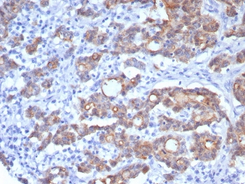 VIL1 Antibody for IHC. Immunohistochemistry analysis of Villin-1 (VIL1) in FFPE human colon adenocarcinoma using VIL1 Antibody / Enterocyte Functional Marker Antibody with recombinant rabbit monoclonal clone rVIL1/8336. HRP-DAB brown staining is observed in tumor epithelial cells with predominantly cytoplasmic and apical localization, highlighting gland-forming structures and luminal surfaces. The staining pattern supports Villin expression in enterocyte-like tumor cells and aligns with its role as a functional marker of intestinal epithelial activity and absorptive cell phenotype in colorectal adenocarcinoma.