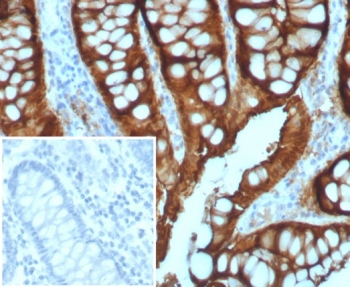 Villin Antibody. Immunohistochemistry analysis of Villin-1 (VIL1) in FFPE human colon adenocarcinoma using Villin Antibody / Microvillus Organization Protein Antibody with recombinant rabbit monoclonal clone VIL1/7378R. Strong HRP-DAB brown staining is observed along the apical membrane of tumor epithelial cells, sharply outlining glandular luminal borders with a dense, continuous pattern consistent with organized microvillus structures and actin bundle architecture. The pronounced apical localization highlights microvilli-rich regions where Villin regulates filament bundling, severing, and capping. Inset shows negative control tissue with PBS in place of primary antibody, confirming specificity of staining.