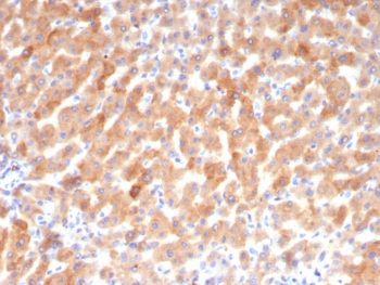 IHC staining of FFPE human hepatocellular carcinoma tissue with Transferrin antibody (clone TF/4794). HIER: boil tissue sections in pH 9 10mM Tris with 1mM EDTA for 20 min and allow to cool before testing.