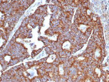 IHC staining of FFPE human hepatocellular carcinoma tissue with Transferrin antibody (clone TF/4797). HIER: boil tissue sections in pH 9 10mM Tris with 1mM EDTA for 20 min and allow to cool before testing.