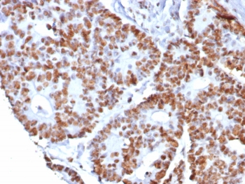 Nucleolin Antibody Recombinant Rabbit mAb NCL/8068R immunohistochemistry analysis of human colon cancer tissue. Formalin-fixed paraffin-embedded human colon cancer stained with Nucleolin Antibody Recombinant Rabbit mAb NCL/8068R. HRP-DAB brown chromogenic staining highlights nuclei of tumor epithelial cells, consistent with the expected nuclear and nucleolar localization of Nucleolin / NCL. HIER: boil tissue sections in pH 9 10mM Tris with 1mM EDTA for 20 minutes and allow to cool before testing.