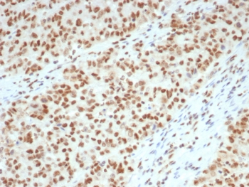 IHC staining of FFPE human colon tissue with Lynch disease with MutL Homolog 1 antibody (clone MLH1/7562). HIER: boil tissue sections in pH 9 10mM Tris with 1mM EDTA for 20 min and allow to cool before testing.