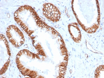 IHC staining of FFPE human prostate carcinoma tissue with Beta Catenin antibody (clone CTNNB1/6807R). HIER: boil tissue sections in pH 9 10mM Tris with 1mM EDTA for 20 min and allow to cool before testing.