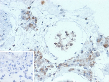 HGAL Antibody Testis IHC. Immunohistochemistry analysis of FFPE human testis tissue stained with HGAL Antibody demonstrates cytoplasmic and focal nuclear HRP-DAB brown staining within scattered germinal center-associated lymphoid cells and immune-associated cellular populations. This germinal center B-cell marker antibody highlights HGAL / GCSAM-associated immune differentiation pathways and lymphoma-related germinal center signaling biology. Inset: PBS used in place of primary antibody demonstrates minimal background staining in the secondary antibody negative control. HIER: boil tissue sections in pH 9 10mM Tris with 1mM EDTA for 20 min and allow to cool before testing.