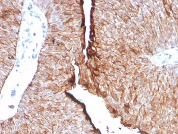 UPK1B Antibody for IHC. Immunohistochemistry analysis of Uroplakin 1B / UPK1B antibody in human urothelial carcinoma tissue using clone UPK1B/8976R. FFPE sections show strong HRP-DAB brown membranous staining in tumor epithelial cells, consistent with the known expression of this urothelial differentiation marker. This Urothelial Differentiation Marker Antibody highlights differentiated tumor epithelial cells within urothelial carcinoma. HIER: boil tissue sections in pH 9 10mM Tris with 1mM EDTA for 20 minutes followed by cooling prior to staining.