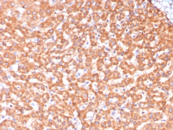 IHC staining of FFPE human hepatocellular carcinoma tissue with ADH1L1 antibody (clone ALDH1L1/7969). HIER: boil tissue sections in pH 9 10mM Tris with 1mM EDTA for 20 min and allow to cool before testing.