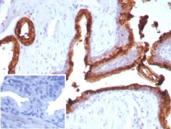 ACP3 Antibody for IHC analysis of Acid phosphatase 3 / Prostatic acid phosphatase in human prostate carcinoma tissue. FFPE human prostate carcinoma tissue was stained with ACP3 Antibody for IHC (mouse monoclonal, clone ACPP/2472) following heat induced epitope retrieval by boiling tissue sections in pH 9 Tris-EDTA buffer (10mM Tris, 1mM EDTA) for 20 minutes and cooling prior to staining. HRP-DAB brown chromogenic signal highlights strong membranous and cytoplasmic staining of prostate tumor epithelial cells forming glandular carcinoma structures, consistent with the known localization of Prostatic acid phosphatase (ACP3 / PAP) in prostate-derived epithelial cells. Detection of ACP3 in prostate carcinoma tissue sections supports its established role as a marker of prostate epithelial differentiation in prostate cancer research. The inset shows the PBS negative control where the primary antibody was omitted, demonstrating absence of specific staining.