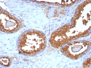PSAP Antibody Recombinant Rabbit MAb ACPP/8409R immunohistochemistry analysis of Prostatic acid phosphatase / ACP3 in human prostate carcinoma tissue. FFPE human prostate carcinoma tissue was stained with PSAP Antibody Recombinant Rabbit MAb ACPP/8409R following heat induced epitope retrieval by boiling tissue sections in pH 9 Tris-EDTA buffer (10mM Tris, 1mM EDTA) for 20 minutes prior to cooling and staining. HRP-DAB brown chromogenic signal highlights strong cytoplasmic and membranous staining of prostate tumor epithelial cells forming glandular carcinoma structures, consistent with the known localization of Prostatic acid phosphatase (ACP3 / PAP) in prostate-derived epithelial cells. Detection of PSAP expression by immunohistochemistry is commonly used in prostate cancer research to identify prostate epithelial lineage and evaluate PAP expression in prostate carcinoma tissues.