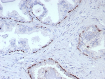 p63 Antibody. Immunohistochemistry analysis of Tumor protein 63 (TP63) in FFPE human prostate cancer tissue using a p63 antibody as a prostate basal cell marker (clone rP40/8765) demonstrates sparse HRP-DAB brown nuclear staining in scattered basal-like cells, while the majority of malignant glandular epithelial cells are negative. The staining is discontinuous and limited, reflecting loss of the basal cell layer that is characteristic of prostate adenocarcinoma. Residual TP63-positive nuclei highlight rare basal or progenitor-associated cells at the periphery of glandular structures. The nuclear-restricted signal and clear absence of staining in tumor cells support the role of TP63 as a marker of basal cell integrity in prostate tissue. Heat-induced epitope retrieval was performed by boiling tissue sections in pH 9 10mM Tris with 1mM EDTA for 20 minutes followed by cooling prior to antibody incubation.