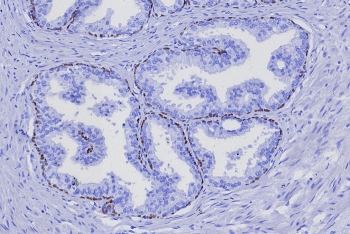 TP63 Antibody Human Prostate Cancer Tissue IHC. Immunohistochemistry staining of FFPE human prostate cancer tissue with TP63 antibody (clone TP63/7807R). HIER: boil tissue sections in pH 9 10mM Tris with 1mM EDTA for 20 min and allow to cool before testing.
