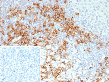 CD38 Antibody human tonsil tissue IHC. Immunohistochemistry analysis of CD38 expression in FFPE human tonsil tissue using CD38 antibody clone CD38/8114R. Strong membranous HRP-DAB brown staining highlights lymphocyte populations within interfollicular regions and surrounding germinal centers, consistent with cell surface localization of this ectoenzyme on immune cells. The staining pattern demonstrates prominent membrane-associated signal with minimal background in surrounding lymphocytes. Inset: PBS was used in place of the primary antibody as a secondary antibody negative control. HIER was performed by boiling tissue sections in pH 9 10 mM Tris with 1 mM EDTA for 20 minutes followed by cooling prior to antibody incubation.