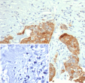 IHC staining of FFPE human bladder tissue with S100P antibody (clone S100P/7978R). Inset: PBS used in place of primary Ab (secondary Ab negative control). HIER: boil tissue sections in pH 9 10mM Tris with 1mM EDTA for 20 min and allow to cool before testing.