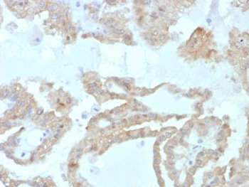 Fatty Acid Binding Protein 2 Antibody RCC IHC. Immunohistochemistry staining of FFPE human renal cell carcinoma tissue with FABP2 antibody (clone FABP2/7669). HIER: boil tissue sections in pH 9 10mM Tris with 1mM EDTA for 20 min and allow to cool before testing.