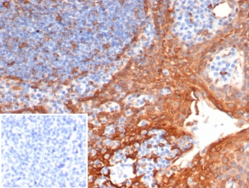 IHC STING1 Antibody Clone STING1/7435 in human tonsil. Immunohistochemistry analysis of STING1 Antibody Clone STING1/7435 in formalin-fixed paraffin-embedded human tonsil tissue. The mouse monoclonal antibody (clone STING1/7435) produces cytoplasmic HRP-DAB brown staining in tonsillar immune cells, consistent with the intracellular localization of Stimulator of interferon genes (STING1 / TMEM173) in innate immune signaling pathways. Lymphoid cells within the tonsillar tissue display positive staining, while the inset shows the PBS-only negative control lacking primary antibody, demonstrating absence of non-specific signal. Antigen retrieval was performed by boiling tissue sections in pH 9 Tris-EDTA buffer (10mM Tris, 1mM EDTA) for 20 minutes followed by cooling prior to antibody incubation.