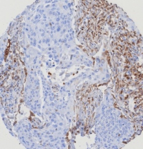 IHC staining of FFPE human lung carcinoma with STING1 antibody STING1/7439. Inset: PBS used in place of primary Ab (secondary Ab negative control). HIER: boil tissue sections in pH 9 10mM Tris with 1mM EDTA for 20 min and allow to cool before testing.