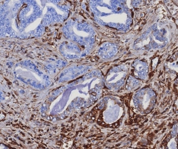 IHC staining of FFPE human prostate carcinoma tissue with MITA antibody STING1/8129R. HIER: boil tissue sections in pH 9 10mM Tris with 1mM EDTA for 20 min and allow to cool before testing.