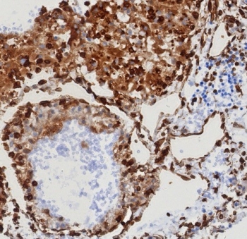 IHC staining of FFPE human renal cell carcinoma with MITA antibody STING1/8129R. HIER: boil tissue sections in pH 9 10mM Tris with 1mM EDTA for 20 min and allow to cool before testing.