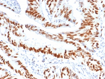 Immunohistochemistry analysis of MCM3 antibody (clone MCM3/6706) in human colon carcinoma tissue. Formalin-fixed, paraffin-embedded human colon carcinoma shows strong nuclear brown staining in malignant epithelial cells, consistent with MCM3 expression in actively proliferating tumor cells, while surrounding stromal cells display weaker or focal nuclear signal. Heat-induced epitope retrieval was performed by boiling tissue sections in pH 9 10mM Tris with 1mM EDTA for 20 min followed by cooling prior to staining.