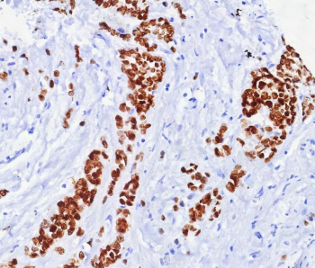 ER alpha Antibody Rabbit Monoclonal Breast Cancer IHC. Immunohistochemistry of ER alpha Antibody in human breast carcinoma. Formalin-fixed, paraffin-embedded human breast carcinoma tissue shows strong nuclear HRP-DAB brown staining in malignant epithelial cells, while adjacent stromal components are largely negative. Staining was performed using rabbit monoclonal clone ESR1/7444R following heat-induced epitope retrieval by boiling tissue sections in pH 9 10 mM Tris buffer with 1 mM EDTA for 20 min and cooling prior to antibody incubation. The nuclear staining pattern is consistent with expected Estrogen Receptor alpha / ESR1 expression in hormone receptor-positive breast carcinoma cells.