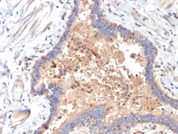 IL6 Antibody COVID-Positive Human Lung Tissue IHC. Immunohistochemical staining of FFPE COVID-positive human lung tissue using IL6 Antibody / Interleukin-6 Antibody (clone IL6/4642) demonstrates prominent cytoplasmic HRP-DAB brown staining within inflammatory cellular infiltrates and pulmonary epithelial-associated compartments. The observed staining pattern is consistent with elevated IL6 expression in an inflamed lung microenvironment and reflects the established role of this pro-inflammatory cytokine in immune activation, cytokine signaling, and regulation of pulmonary inflammatory responses. Detection of IL6 within COVID-associated lung pathology supports the utility of this antibody for investigating cytokine-driven inflammation, immune-mediated tissue injury, and mechanisms of inflammatory disease progression. HIER: boil tissue sections in pH 9 10mM Tris with 1mM EDTA for 20 min and allow to cool before testing.