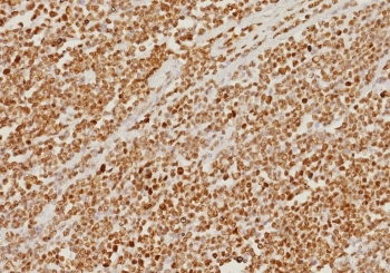 IHC staining of FFPE human colon carcinoma tissue with PMS2 antibody (clone PMS2/8374R). HIER: boil tissue sections in pH 9 10mM Tris with 1mM EDTA for 20 min and allow to cool before testing.