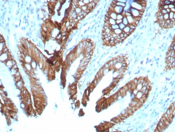 Cadherin 17 Antibody Colon IHC. Immunohistochemistry staining of FFPE human colon tissue with Cadherin 17 antibody (clone rCDH17/8512). HIER: boil tissue sections in pH 9 10mM Tris with 1mM EDTA for 20 min and allow to cool before testing.
