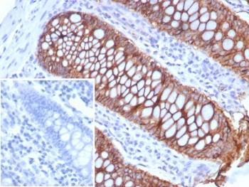 LI Cadherin Antibody Colon IHC. Immunohistochemistry staining of FFPE human colon tissue using LI Cadherin Antibody / CDH17 Antibody (recombinant mouse monoclonal clone rCDH17/8514) demonstrates strong membranous HRP-DAB brown staining along the lateral borders of colonic epithelial cells. The staining pattern is consistent with expression of Cadherin 17 (CDH17, LI-cadherin), a calcium-dependent cell adhesion molecule that contributes to epithelial organization, maintenance of tissue integrity, and regulation of cell-cell interactions within the gastrointestinal tract. Prominent membrane-associated staining highlights well-organized glandular crypt structures and preserved epithelial polarity, while surrounding stromal tissues exhibit minimal background reactivity. The inset image shows the negative control in which PBS was substituted for the primary antibody. HIER was performed by boiling tissue sections in pH 9, 10 mM Tris with 1 mM EDTA for 20 minutes followed by cooling prior to immunostaining.