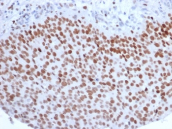 Enhancer of zeste homolog 2 Antibody Bladder Carcinoma IHC. Immunohistochemistry staining of FFPE human bladder carcinoma with Enhancer of zeste homolog 2 antibody (clone EZH2/6988). HIER: boil tissue sections in pH 9 10mM Tris with 1mM EDTA for 20 min and allow to cool before testing.