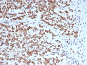 IHC staining of FFPE human Lynch syndrome colon carcinoma tissue with Enhancer of zeste homolog 2 antibody (clone EZH2/6988). HIER: boil tissue sections in pH 9 10mM Tris with 1mM EDTA for 20 min and allow to cool before testing.