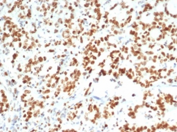 Enhancer of zeste homolog 2 Antibody Human Bladder Carcinoma Tissue IHC. Immunohistochemistry analysis of FFPE human bladder carcinoma with Enhancer of zeste homolog 2 antibody (clone EZH2/6988). HIER: boil tissue sections in pH 9 10mM Tris with 1mM EDTA for 20 min and allow to cool before testing.