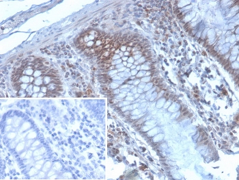 KMT6 Antibody Colon Carcinoma IHC. Immunohistochemistry staining of FFPE human colon carcinoma tissue with KMT6 antibody (clone EZH2/4194). Inset: PBS used in place of primary Ab (secondary Ab negative control). HIER: boil tissue sections in pH 9 10mM Tris with 1mM EDTA for 20 min and allow to cool before testing.