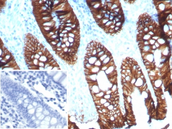 CDH17 Antibody Colon IHC. Immunohistochemical analysis of CDH17 in FFPE human colon tissue using a CDH17 / Cadherin 17 antibody rabbit monoclonal (clone CDH17/8515R). Strong membranous staining is observed in intestinal epithelial cells lining colonic glands, consistent with Cadherin 17 expression in gastrointestinal epithelium. Heat-induced epitope retrieval was performed by boiling tissue sections in 10 mM Tris with 1 mM EDTA, pH 9, for 20 minutes followed by cooling prior to staining. Inset shows a negative control section processed in parallel using PBS in place of the primary antibody, demonstrating minimal background staining.