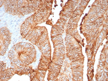 Immunohistochemistry of CDH17 antibody in human colon tissue. The recombinant rabbit mAb clone CDH17/8158R demonstrates strong membranous HRP-DAB brown staining along the lateral borders of colonic epithelial cells, consistent with Cadherin 17 localization in intestinal epithelium. Staining highlights well-organized glandular crypt structures with preserved epithelial polarity, while surrounding stromal tissue shows minimal background signal. The negative control inset, using PBS in place of the primary antibody, shows no specific staining. Heat-induced epitope retrieval was performed by boiling tissue sections in pH 9 10mM Tris with 1mM EDTA for 20 minutes followed by cooling prior to incubation.