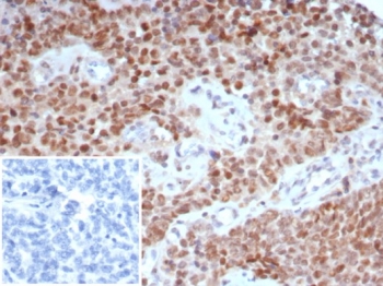 Tricho-rhino-phalangeal syndrome type I Antibody immunohistochemistry analysis in human ovary tissue. FFPE human ovary tissue stained with Tricho-rhino-phalangeal syndrome type I Antibody shows strong nuclear staining in epithelial cells, consistent with TRPS1 localization as a transcription factor. A recombinant rabbit monoclonal format (clone TRPS1/7912R) was used for detection. The inset represents a negative control using PBS in place of the primary antibody, confirming staining specificity. Antigen retrieval was performed using pH 9 Tris-EDTA buffer with heat-induced epitope retrieval prior to staining, and hematoxylin counterstain highlights nuclei (blue).
