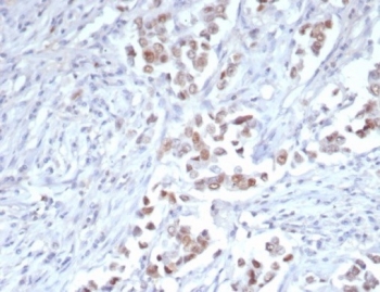 Tricho-rhino-phalangeal syndrome type I Antibody immunohistochemistry analysis in human breast carcinoma tissue. FFPE human breast carcinoma stained with Tricho-rhino-phalangeal syndrome type I Antibody demonstrates strong nuclear staining in tumor epithelial cells, consistent with TRPS1 expression as a nuclear transcription factor. Detection was performed using clone TRPS1/7912R at 2 ug/ml, showing clear nuclear localization within malignant cells. Antigen retrieval was carried out using pH 9 Tris-EDTA buffer with heat-induced epitope retrieval, and hematoxylin counterstain highlights nuclei (blue).
