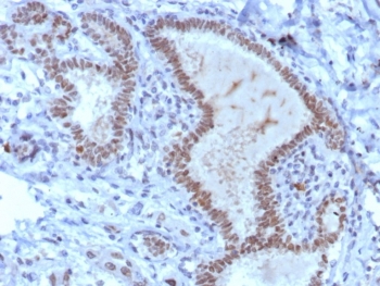 TRPS1 Antibody immunohistochemistry analysis in triple negative human breast carcinoma tissue. FFPE triple negative human breast carcinoma stained with TRPS1 antibody demonstrates strong nuclear staining in tumor epithelial cells, consistent with TRPS1 localization as a transcription factor and its established role as a breast cancer marker. Detection was performed using recombinant rabbit monoclonal clone TRPS1/8008R at 2 ug/ml. Antigen retrieval was carried out using pH 9 Tris-EDTA buffer with heat-induced epitope retrieval, and hematoxylin counterstain highlights nuclei (blue).