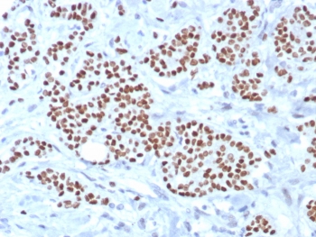 TRPS1 Antibody immunohistochemistry analysis in human breast carcinoma tissue. FFPE human breast carcinoma stained with TRPS1 antibody demonstrates strong nuclear staining in tumor epithelial cells, consistent with TRPS1 localization as a transcription factor and its role as a breast cancer-associated marker. Detection was performed using recombinant rabbit monoclonal clone TRPS1/8008R. Antigen retrieval was carried out using pH 9 Tris-EDTA buffer with heat-induced epitope retrieval, and hematoxylin counterstain highlights nuclei (blue).
