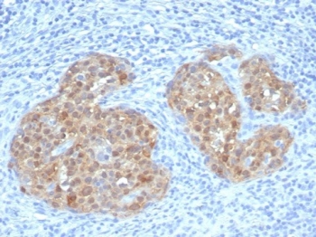 Immunohistochemistry of CDKN2A antibody in human cervical carcinoma tissue. The mouse monoclonal clone rCDKN2A/7659 demonstrates strong nuclear and cytoplasmic HRP-DAB brown staining in malignant epithelial cell clusters, consistent with overexpression of p16INK4a in RB pathway dysregulation. Tumor cell nests are clearly highlighted against surrounding stromal and inflammatory cells, which show minimal background staining. Heat-induced epitope retrieval was performed by boiling tissue sections in pH 9 10mM Tris with 1mM EDTA for 20 minutes followed by cooling prior to antibody incubation.