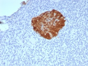 Immunohistochemistry of P16INK4a antibody in human cervical carcinoma tissue. The rabbit monoclonal clone CDKN2A/7660R demonstrates strong nuclear and cytoplasmic HRP-DAB brown staining in a discrete cluster of malignant epithelial cells, consistent with overexpression of Cyclin-dependent kinase inhibitor 2A in RB pathway dysregulation. Surrounding stromal and inflammatory cells show minimal to no specific staining, providing clear contrast with the positive tumor focus. Heat-induced epitope retrieval was performed by boiling tissue sections in pH 9 10mM Tris with 1mM EDTA for 20 minutes followed by cooling prior to antibody incubation.
