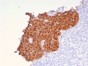 Immunohistochemistry of P16INK4a antibody in human cervical carcinoma tissue. The recombinant rabbit mAb clone CDKN2A/8196R shows strong, diffuse nuclear and cytoplasmic HRP-DAB brown staining in malignant epithelial cells, a pattern commonly associated with dysregulated RB pathway signaling in cervical neoplasia. Tumor cells display uniform positivity with sharp contrast against adjacent non-neoplastic stromal and inflammatory cells, which remain largely unstained. Heat-induced epitope retrieval was performed by boiling tissue sections in pH 9 10mM Tris with 1mM EDTA for 20 minutes followed by cooling prior to antibody incubation.