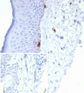 MART-1 Antibody Human Skin Tissue IHC. Immunohistochemistry staining of FFPE human skin tissue with MART-1 antibody (clone rMLANA/8134). Inset: PBS used in place of primary Ab (secondary Ab negative control). HIER: boil tissue sections in pH 9 10mM Tris with 1mM EDTA for 20 min and allow to cool before testing.