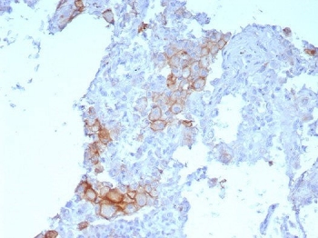 Immunohistochemistry analysis of PD-L1 antibody in human lung squamous cell carcinoma. Programmed cell death 1 ligand 1 Antibody Rabbit MAb PDL1/7568R was used for immunohistochemistry on FFPE human lung squamous cell carcinoma tissue. Distinct HRP-DAB brown membranous staining is observed in tumor epithelial cells, consistent with the cell surface localization of Programmed death-ligand 1 (PD-L1 / CD274), an immune checkpoint ligand that regulates T cell responses within the tumor microenvironment. The staining highlights clusters of malignant squamous epithelial cells showing membranous PD-L1 expression, while surrounding stromal elements display minimal signal. The rabbit monoclonal antibody clone PDL1/7568R detects PD-L1 expression in tumor cells of lung squamous cell carcinoma following heat-induced epitope retrieval using pH 9 Tris-EDTA buffer.