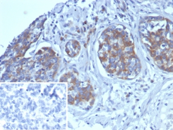 AMBP Antibody Ovarian Cancer IHC. Immunohistochemistry analysis of formalin-fixed, paraffin-embedded human ovarian carcinoma tissue stained with AMBP Antibody demonstrates prominent cytoplasmic HRP-DAB brown staining within tumor epithelial cell populations, consistent with Alpha-1-microglobulin-bikunin precursor / AMBP-associated extracellular glycoprotein expression. Surrounding stromal components demonstrate comparatively weaker staining, supporting enrichment of AMBP-associated secretory pathway signaling within neoplastic epithelial structures. This plasma glycoprotein marker antibody highlights extracellular regulatory signaling and secretory protein-associated biology in ovarian cancer tissue. Inset: PBS used in place of primary antibody demonstrates minimal background staining in the negative control section. Heat-induced epitope retrieval was performed by boiling tissue sections in pH 9 10mM Tris with 1mM EDTA for 20 min followed by cooling prior to antibody incubation.
