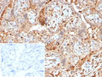 Alpha 1 Microglobulin Antibody Placenta IHC. Immunohistochemistry of Alpha 1 Microglobulin Antibody Mouse Monoclonal AMBP/4536 in human placental tissue. Formalin-fixed, paraffin-embedded human placenta sections demonstrate cytoplasmic HRP-DAB brown staining in trophoblastic epithelial cells consistent with Alpha-1-microglobulin (AMBP) expression. Surrounding stromal components show comparatively weaker staining. The inset panel shows PBS used in place of primary antibody as a negative control, demonstrating minimal background signal. Heat-induced epitope retrieval was performed by boiling tissue sections in pH 9 10 mM Tris with 1 mM EDTA for 20 min followed by cooling prior to antibody incubation.